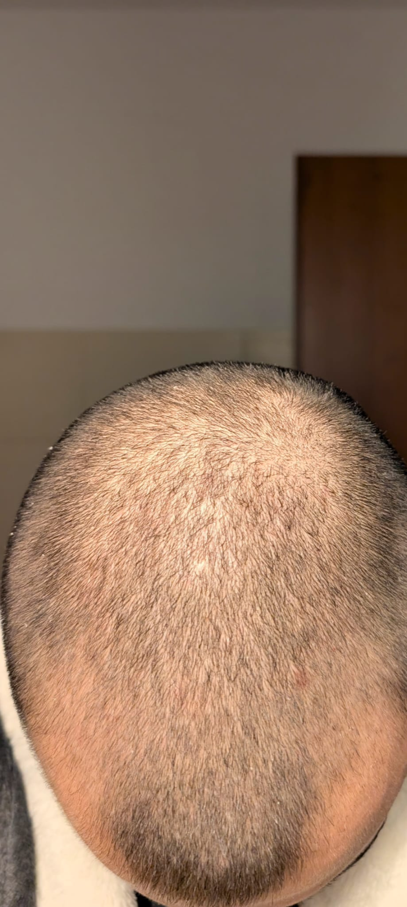 Earlier top-down crown photo from the founder's real hair tracking timeline
