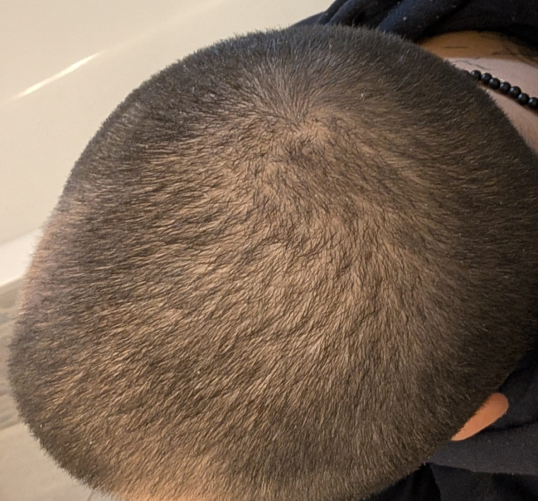 Later top-down crown photo from the founder's real hair tracking timeline